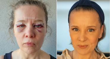 Anna Powierza przeszła operację plastyczną powiek: Ludzie myśleli, że jestem po solidnym mordobiciu!